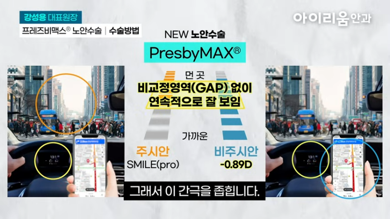 40-50대 스마일라식, 노안도 교정 가능한가요?