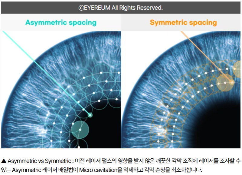 스마일라식, 스마일프로, 스마트노바 차이점은? 레이저 장비부터 수술법, 가격까지 비교 사진 8