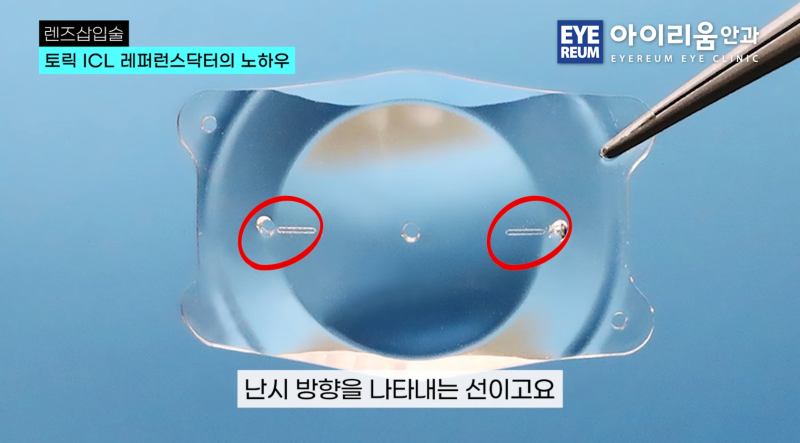 추석 ICL 렌즈삽입술, 원하는 날짜에 수술하려면 미리 검사해야 하는 이유 사진 4